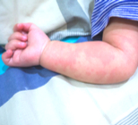 מנינגוקוקסמיה - תמונת אווירה