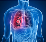 סרטן ריאה של התאים הלא קטנים - תמונת המחשה