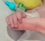 רטינופתיה של פגות - תמונת המחשה