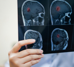 גידול במוח - תמונת המחשה