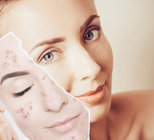 אחת ולתמיד: מהי הדרך היעילה ביותר לטיפול באקנה?-תמונה