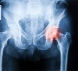 שוויון באורך הרגליים לאחר ניתוח להחלפת מפרק הירך-תמונה