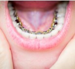 אורתודונטיה אסתטית ממוחשבת – יישור שיניים בהתאמה אישית-תמונה