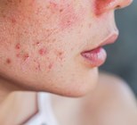 אקנה בפנים – לפני הטיפול, אלה הדברים החשובים שצריך לדעת-תמונה