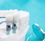 רגע לפני ניתוח, כדאי לשקול לבצע שתלים קצרים-תמונה