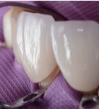 ציפוי שיניים: טיפול מוביל ברפואת שיניים מתקדמת-תמונה