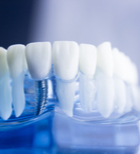 שתלים דנטליים למחוסרי עצם -תמונה