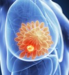 סרטן השד: גילוי מוקדם של המחלה הוא הכרח-תמונה