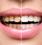 שיקום שיניים