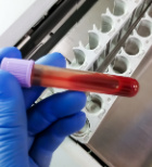 סרטן הדם לוקמיה – תסמינים וסימני אזהרה -תמונה