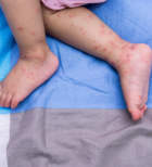 הפה והגפיים - מחלת ילדי גן שמדביקה גם את ההורים-תמונה