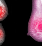 הטיפול הניתוחי בסרטן השד-תמונה