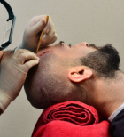 השתלת שיער בישראל או בטורקיה? העיקר ביד מקצועית-תמונה