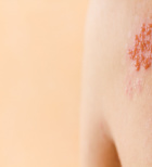 שלבקת חוגרת: כל מה שחשוב לדעת על המחלה, התסמינים והטיפול-תמונה