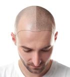 נשירת שיער גברים - תמונת אווירה