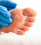 יבלת שורש – קטנה אבל מציקה-תמונה