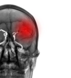 דו"ח מבקר המדינה חושף: ליקויים בטיפול ובשיקום נפגעי שבץ מוחי בישראל-תמונה