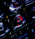 מחלות מסתמיות: חשיבות הערכה מקצועית ע"י מומחה במחלות מסתמיות ואקוקרדיוגרפיה מתקדמת-תמונה