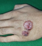 שושנת יריחו: מאות נדבקים באופקים – המחלה מתפשטת למרכז -תמונה