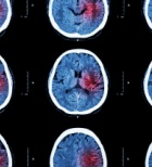 שבץ המורגי - תמונת המחשה