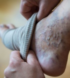 בצקת בכף הרגל - תמונת אווירה