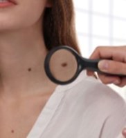 נקודות חן וגידולי עור: סימני אזהרה, אבחון וטיפול-תמונה