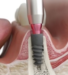 אירופאיים או ישראליים? כל מה שצריך לדעת על שתלים דנטליים-תמונה