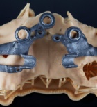 נסיגת עצם בפה - תמונת המחשה