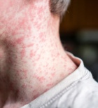 התפרצות חצבת בישראל: האם אנחנו בפתחו של גל תחלואה חדש?-תמונה