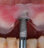 מהפכת השתלים הדנטליים למטופלים עם מחלות רקע -תמונה