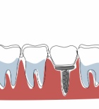 השתלות שיניים ביום אחד – איך זה עובד ומה חשוב לדעת?-תמונה