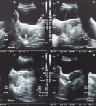  אולטרסאונד שרירן ברחם