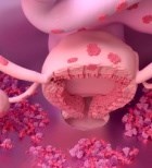 אנדומטריוזיס - הגדרה, תסמינים וטיפול-תמונה