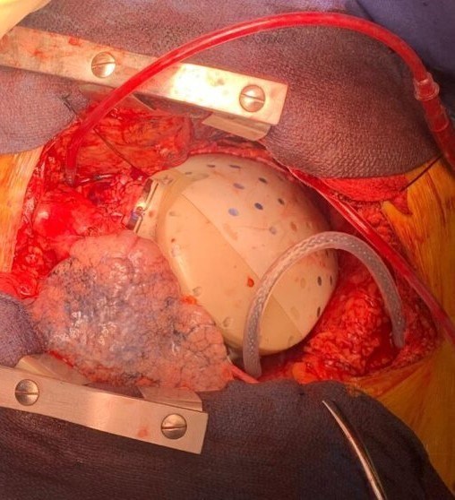 השתלת לב מלאכותי: הטכנולוגיה שמשנה את חוקי המשחק עבור חולי הלב-תמונה