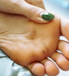 לדרוך על היבלת: מהפכה בטיפול ביבלות ויראליות-תמונה