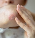 פסוריאזיס 2025: כל מה שצריך לדעת ביום הפסוריאזיס הבינלאומי-תמונה