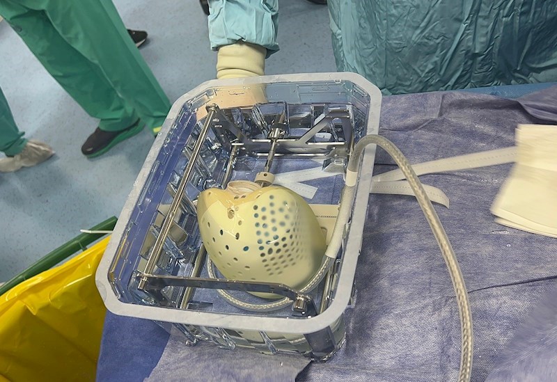 לב מלאכותי. צילום: דוברות שיבא