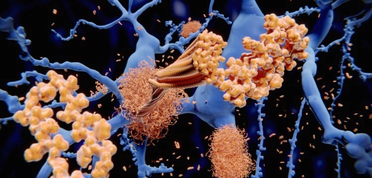 משקעי עמילואיד בטא במוחו של חולה אלצהיימר. צילום: שאטרסטוק