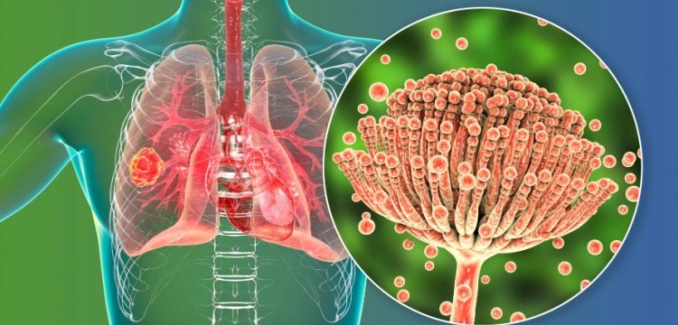 אספרגילוזיס ריאתי