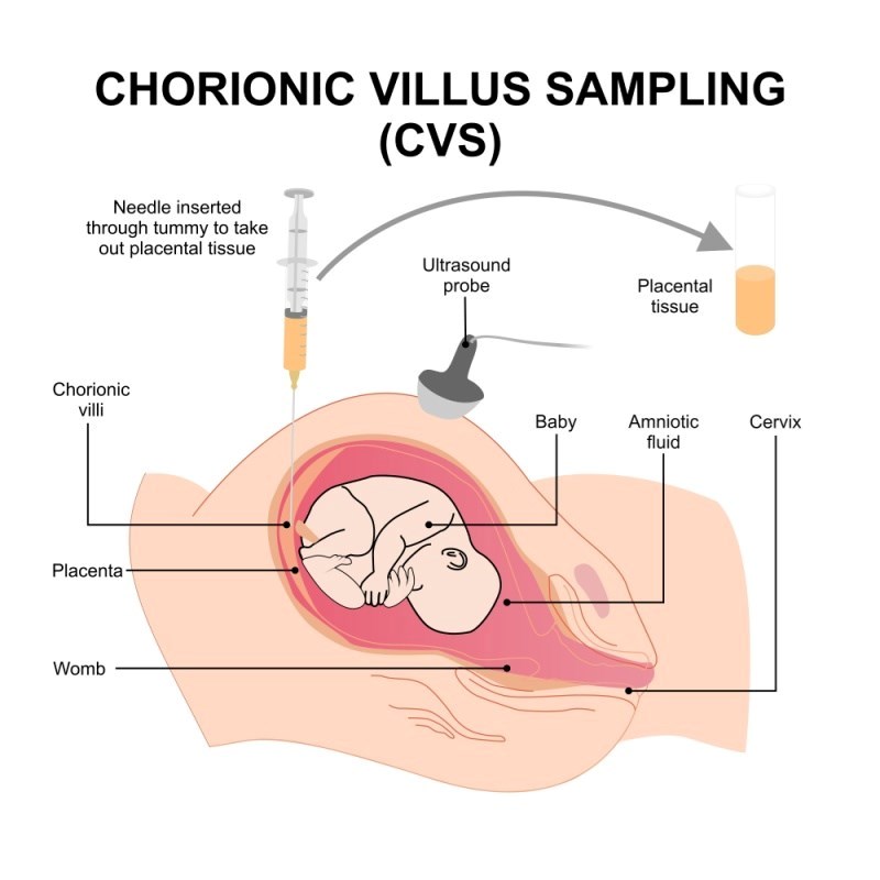 בדיקת סיסי שליה