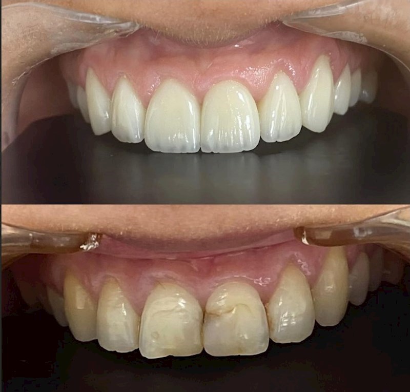 שיניים במראה טבעי