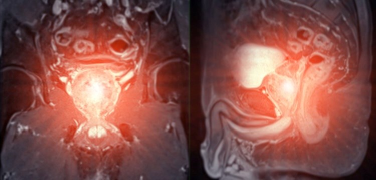 ערמונית מוגדלת