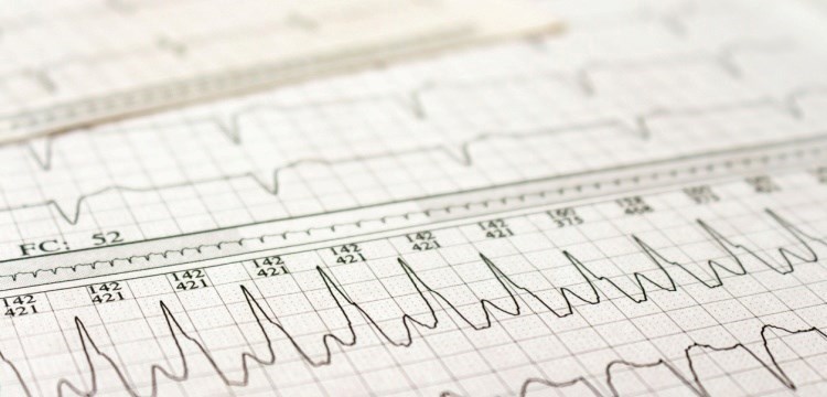 הפרעות בקצב לב