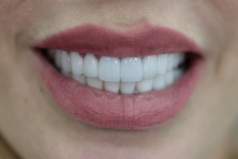 חיוך מושלם פרפשרשן