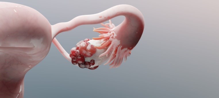 ציסטה בשחלה