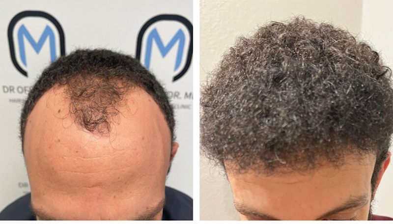 משמאל לפני ההשתלה. מימין, אחרי ההשתלה באדיבות ד"ר עופר מור