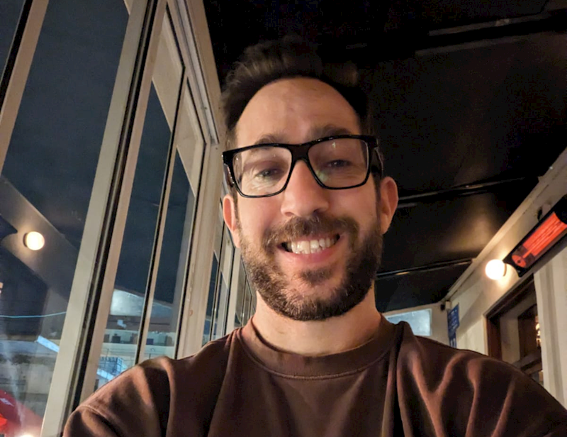 גיל קלמן אחרי השתלת שיער אצל ד"ר עופר מור