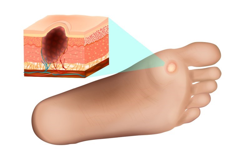 זיהום, פצע או פטריה צריכים להדליק נורה אדומה. הדמיה: שאטרסטוק