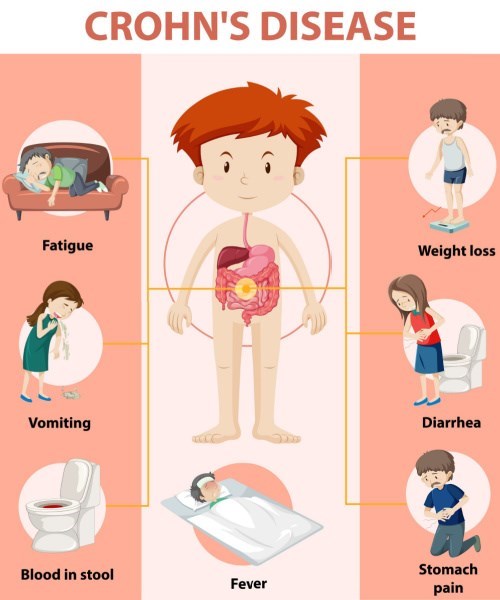 מכלול תסמיני מחלת קרוהן.