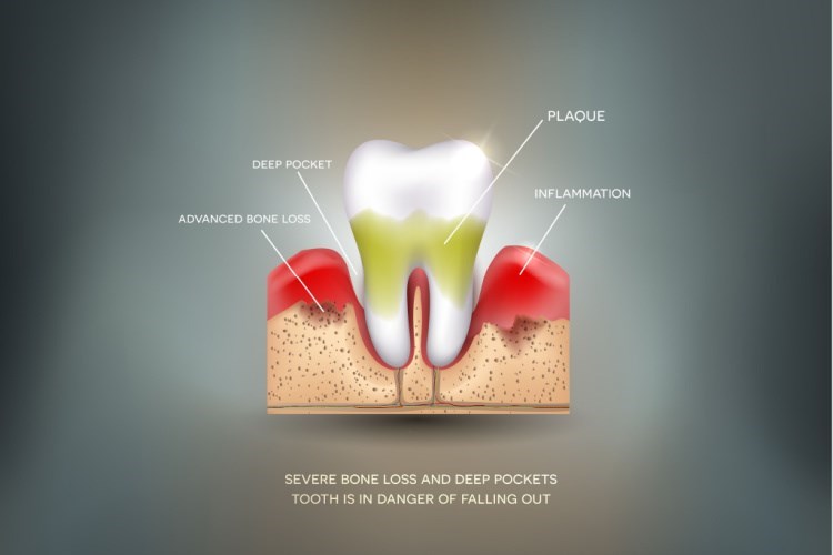 דלקת במוך השן